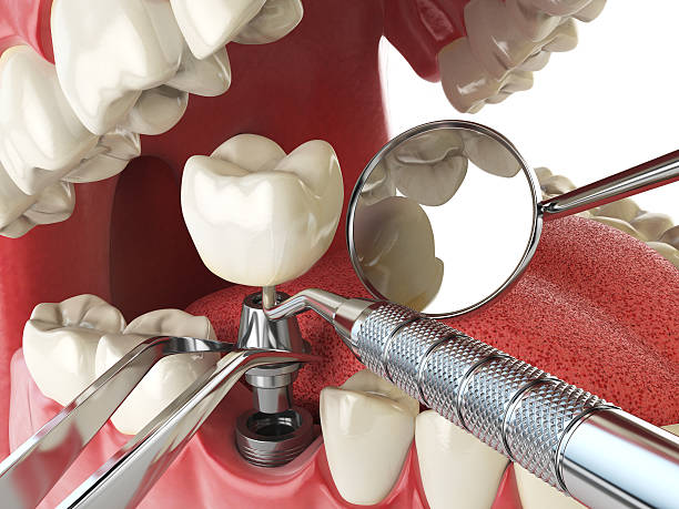 Best Lost Filling or Crown Replacement in Babbitt, MN
